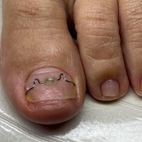 Коррекция скрученных и врастющих ногтей