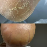 Восстановление стоп и ногтей